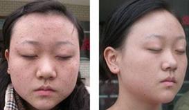 扁平疣治疗对比