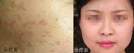 除去扁平疣 工作好心情