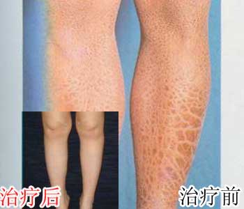 中山皮肤病医院帮她摆脱16年“鱼儿身”