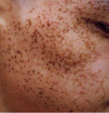 南昌黄褐斑症状