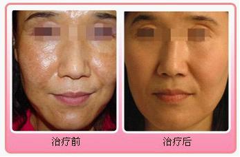 �ƺְ�����ȥ��