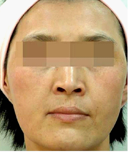 黄褐斑形成原因