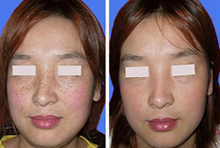 黄褐斑晒斑该怎么区别