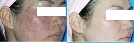 黄褐斑如何治疗