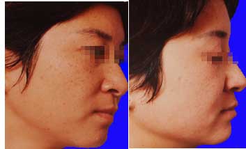 黄褐斑如何去除