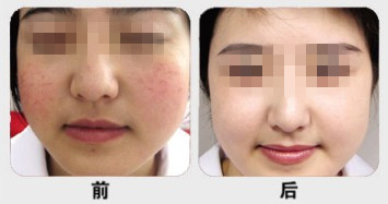 黄褐斑如何祛掉