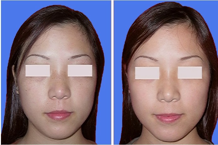 黄褐斑的治疗方法