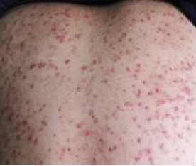 背部毛囊炎症状