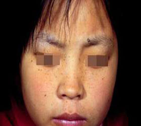 黄褐斑的症状