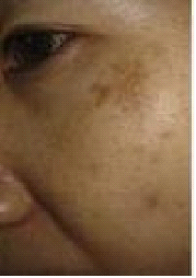 黄褐斑的症状