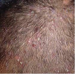 头部毛囊炎症状