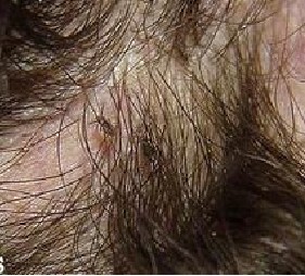 男性阴囊毛囊炎