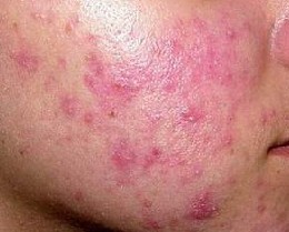 面部毛囊炎症状