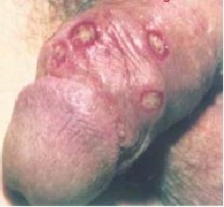 生殖器毛囊炎症状