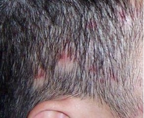 头皮毛囊炎症状