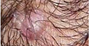 Å®ÐÔëÄÒÑ×Ö¢×´