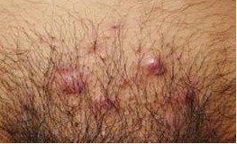 阴毛囊炎