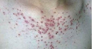 糠秕孢子菌毛囊炎图片