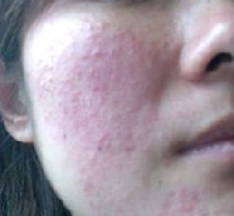 皮肤过敏引起的症状