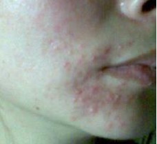 面部皮肤过敏