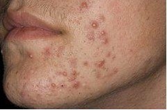 面部毛囊炎治疗