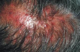 头皮毛囊炎治疗