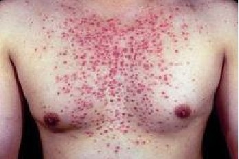 糠秕孢子菌毛囊炎