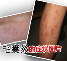 毛囊炎的图片