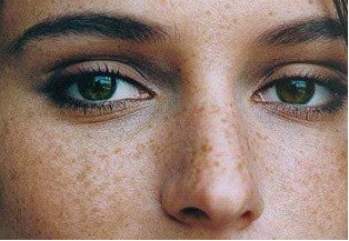 黄褐斑为什么也称“肝斑”