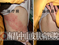 CPC牛皮癣整体康复疗法攻克多年牛皮癣
