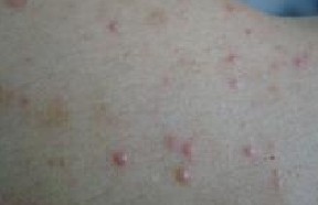 µÃÁËëÄÒÑ×´«È¾Âð