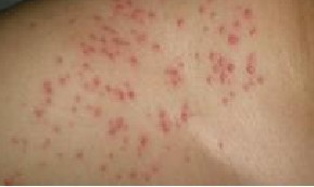 毛囊炎的由来和发展