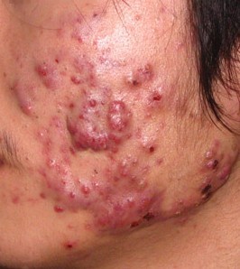 毛囊炎会传染吗