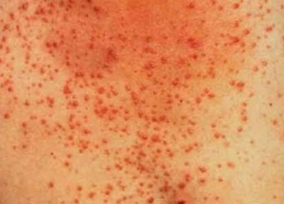 腿部毛囊角化症状