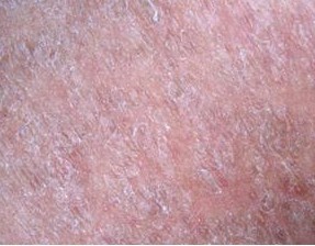 鳞状毛囊角化症