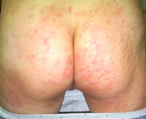 小儿毛囊角化症