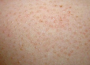 毛囊角化症图片