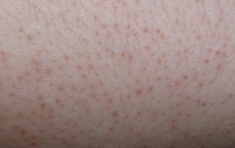 治疗毛囊角化病