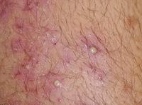 根治毛囊角化症