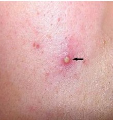 毛囊角化症症状