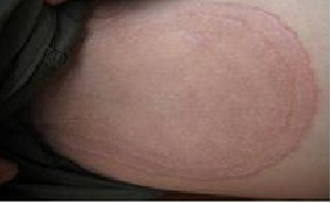 如何治疗毛囊角化病