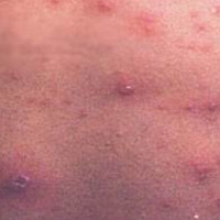 得了疥疮怎么办