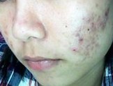 痤疮的预防方法