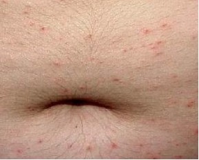 疥疮是怎么引起的?