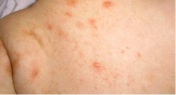 疥疮是怎么传染上的