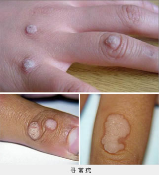 寻常疣产生的原因是什么