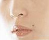 嘴唇长寻常疣的发病原因