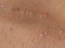 寻常疣具有扩散的能力吗