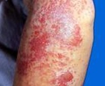 湿疹患者的日常预防