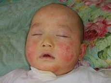 如何预防婴儿湿疹的出现